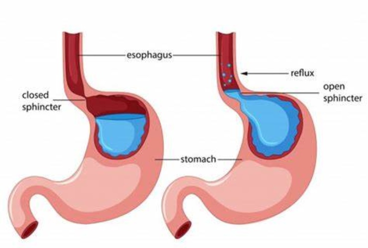 Disturbo gastroesofageo, metodo Trabucco