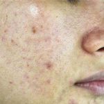 Pelle con acne